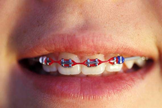 Braces – Dental Cosmetics